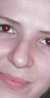 This is a PREOP picture. You can already see the tilting to one side; one side of the nose is simply 'fatter'.