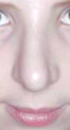 POSTOP. Looks like what I can only call a banana-shape... There seems to be much more focus on this now. Considering my nose postop, I can't rationally believe this is all swelling.