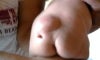 lipoma at lower back pic1