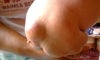 lipoma at lower back pic2
