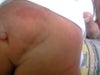 lipoma at lower back pic3