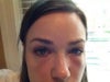 Very bad swelling after restylane under eyes.