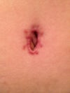 BB scar - 3 months post op