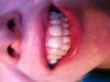 After invisalign