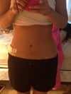 One week post op
