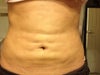 second week post op