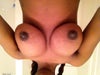 18 days after implants left higher