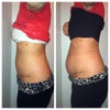 These were both taken the day the bulging started. I am relaxing my musclesin both photos.