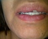 Before Reduction,