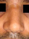 After Front - Notice the lifted tip & Big nostrils, 1 looks smaller; due to being stuck closed by scabs inside.