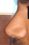 After Side - Notice the swelling between the eyes, feels hard, will it go down?
