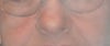 My nose before Rhinoplasty