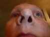 My nose Now, 7 weeks post op. It's still bulbous and the left side very swollen & bruised