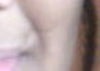 my intial scar...before undergoing any treatment