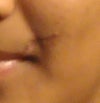 my scar-- after undergoing laser treatment of 8 sittings