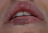 See notes on picture. The red you see below the fordyce spots is what added (you can see it goes inside of the mouth and doesn't change the frontal appearance)