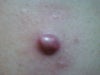 last week biopsy aggravated after 9 mnths(May 2012)