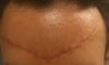 2-weeks post-op. dissolvable suturing done from the inside. doctor says to put nothing on it. after surgery it formed a thin scab, which he picked off with tweezers. w
