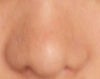 nose collapsed