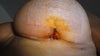 4 1/2 weeks after surgery