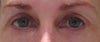 see less white on outside corner of right eye (my left). Lower lid is pulled up too high and upper lid droops down. My doctor first told me it was a simple procedure to correct and certainly everything I read on the net confirmed this. Post op my doctor now tells me it's a tricky thing to get the eyes looking even as a millimeter can make a big difference. I also experience a tugging feeling on the outside corners of my eye as I blink and look left to right.