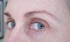 looking to my left. Eyeball is obscured especially by upper lid. Vision is impaired and it looks so ugly. I have the same problem with the other eye but it's not as pronounced. I'm also told I have a dissolving stitch on the outside corner of each eye that will take 6 to 9 months to dissolve. BTW my surgeon is considered one of the best in my country for cosmetic surgery and I'm told he studied the ectropion repair under the New York surgeon who developed the procedure. Someone called Lipman? My surgeon advised I tug at the eye to try and stretch the lower lid and that I had a 50/50 chance it may correct itself. It's now been 3 months since the procedure and although it has loosened slightly I'm still left with impaired vision when glancing sideways. I just want my pretty eyes back. If I can get the look right then I'm prepared to live with having to tape my eye closed at night as I am currently doing.