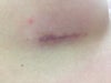 looking at the picture, on the left side of my incision.