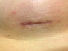 looking at the picture, on the left side of my incision.