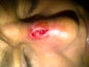 nose after the fall when it became infected