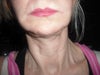 this was just taken  after surgery ,I thank i look worse after thousands spent