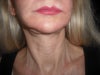 after surgery with holding neck up high still shows under neck and jawls