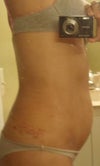 after lipo one week