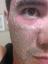 You can see where the lower eyes peeled from the Fully ablative CO2 Ultrapulse. NO peeling at all from the Fraxel :Repair at 50 MJ. Is it normal for the repair to not peel? If it does not peel, then I am assuming repair works primarily from collagen buildup over the next 6 months? I thought even fractional Co2 lasers such as repair ablate a layer of skin off. I know they drill microscopic holes into the skin as well. Thanks again for your time doctors.