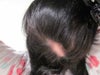 Bald spot from swollen lymph nodes