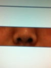 nose 17 days after alar base reduction