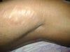 This is how the stretch marks looks on my thigh