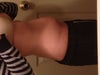 2 day pre op of abs