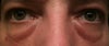 These are my eyes on a daily basis. What is odd is that if I sleep 5-6 hours a night the swelling goes down vs sleeping 8-10 hours a night. I have tried ever cream and nothing works. Only a strict vegan diet makes them go away.
