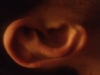 the right ear with similar swelling but less