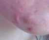 This the keloid scar on my chin next to a massive cyst. It has become larger and more painful since the dosage increase.