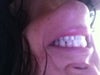 Small lateral incisor and gaps.