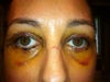 6 days after surgery