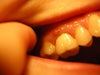 Gum boil from deep abscess at root.