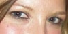 Before upper blepharoplasty