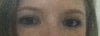 After blepharoplasty (with eyeliner on)