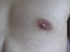 left nipple.