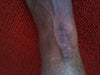 Scar  discoloration, happened in the first few months of receiving Cysplatin  &  Bleyomycin. When scars healed, they left my skin discoreded (darkened) in those areas.