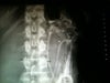 Xray of barium swallow. I had hoped this would lead the doctor to telling me if I have done myself any damage or where the problem is stemming from