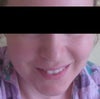 Two years following bunt force facial trauma, left side