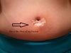The incision is great, but because I can't really feel the pain, I'm worried if more is going on then I know. I just know, I feel a lump again.